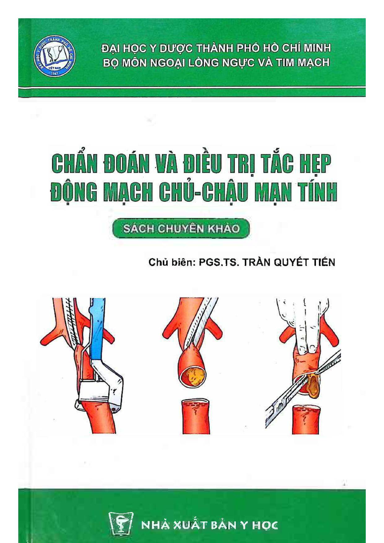 Chẩn đoán và điều trị tắc hẹp ĐM chủ-chậu mạn tính